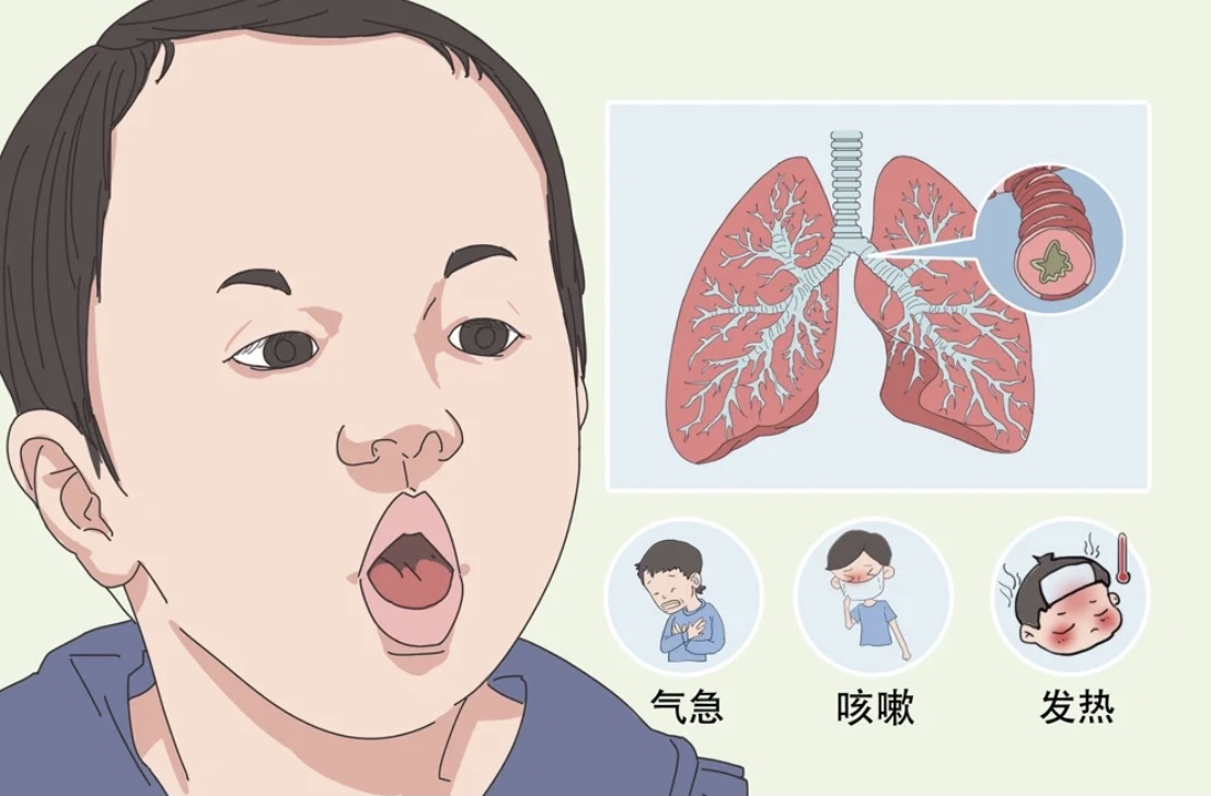小孩子依舊咳嗽不止
